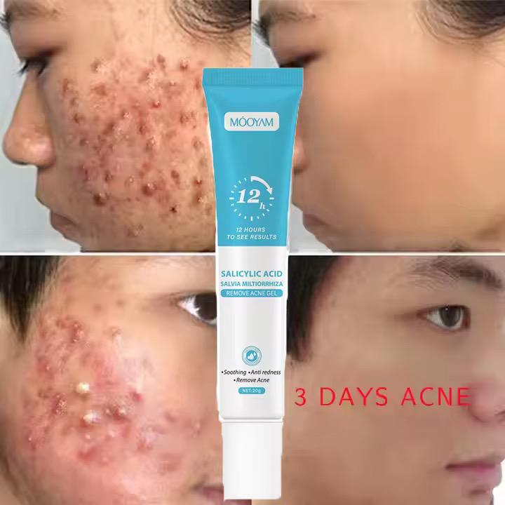 . 🌿 Gel Anti-Acné à l’Acide Salicylique – Résultats visibles en 5 jours!