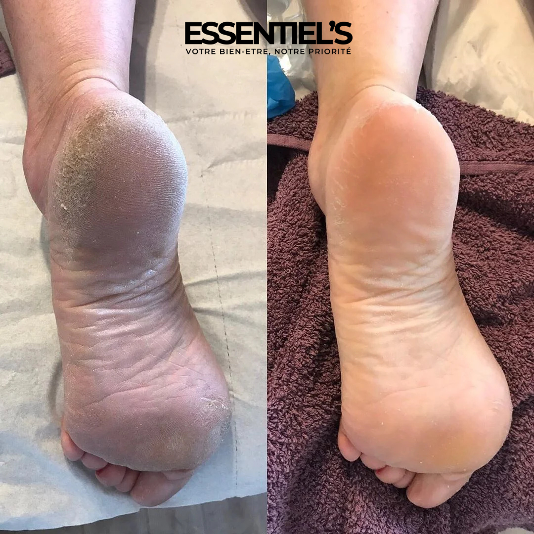 FOOT PEEL MASK™  - Retrouvez maintenant vos jolis pieds de bébé !