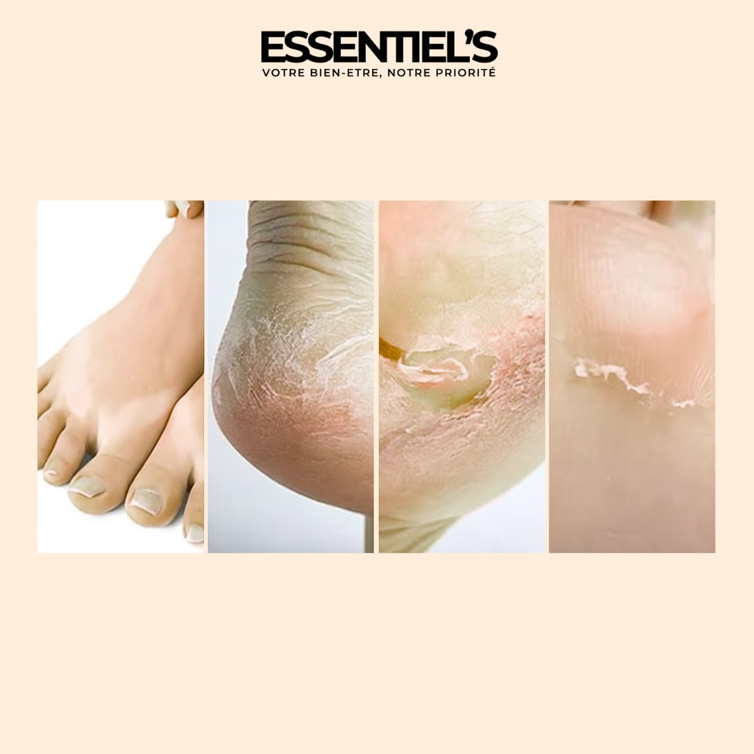FOOT PEEL MASK™  - Retrouvez maintenant vos jolis pieds de bébé !