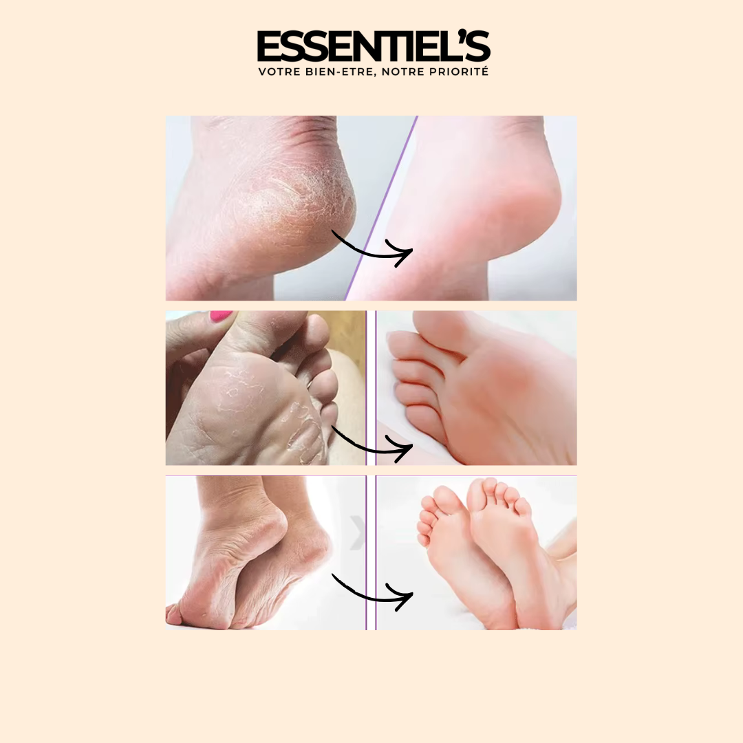 FOOT PEEL MASK™  - Retrouvez maintenant vos jolis pieds de bébé !