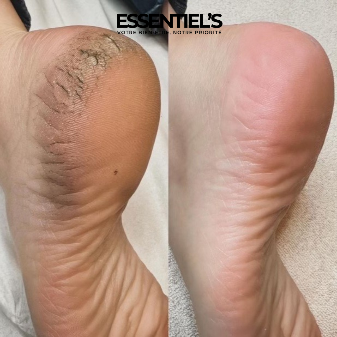 FOOT PEEL MASK™  - Retrouvez maintenant vos jolis pieds de bébé !