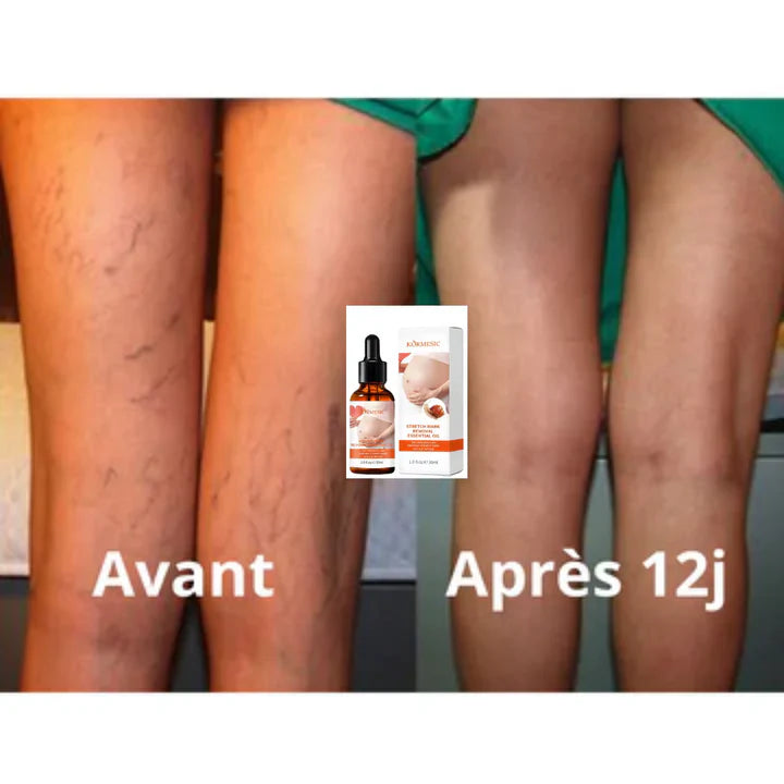 🥇 Huile Anti-Vergetures  – Résultats Visibles en 10 Jours